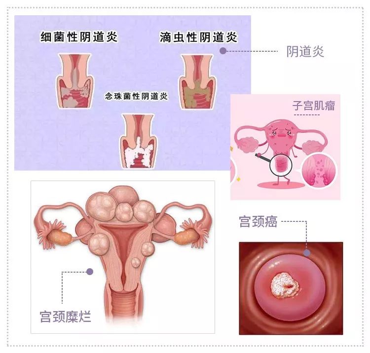 细菌性阴炎什么症状