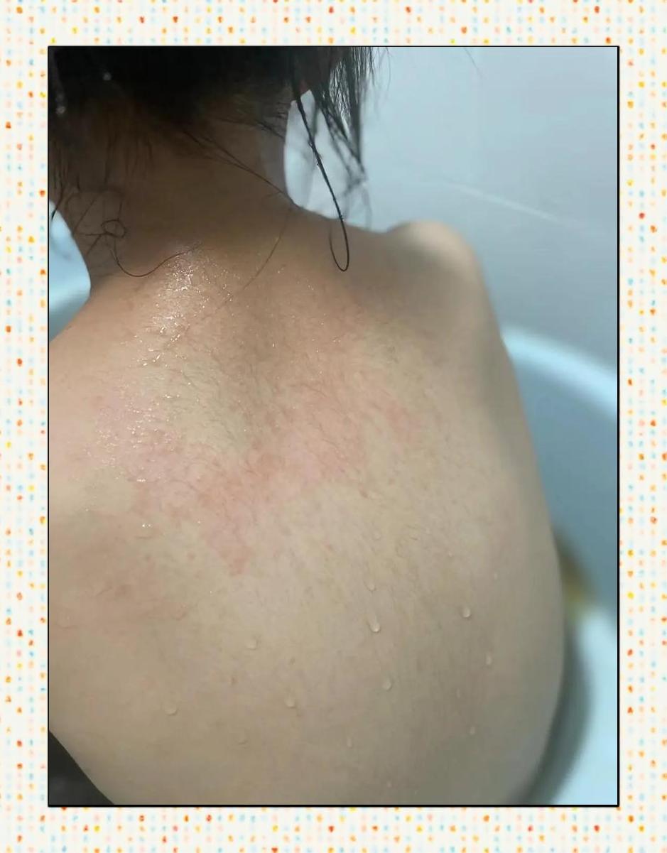 什么是痱子?