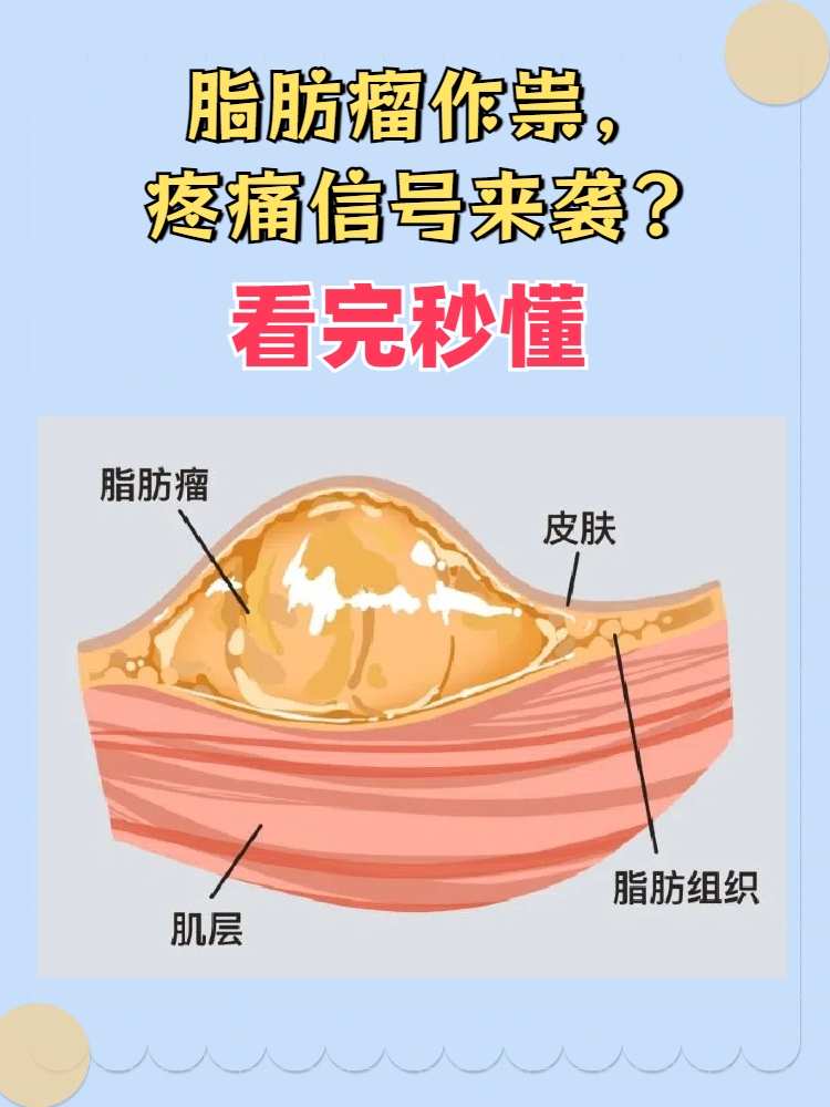 脂肪瘤需要切除吗