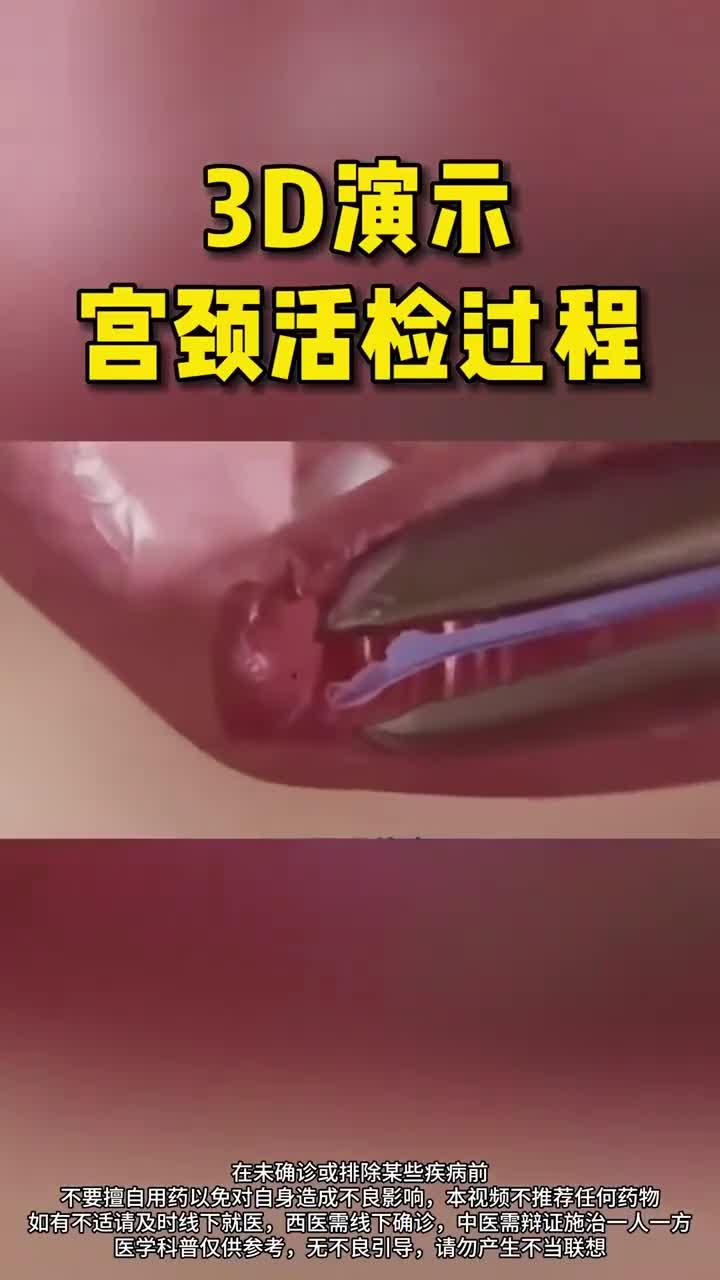 宫颈活检疼吗