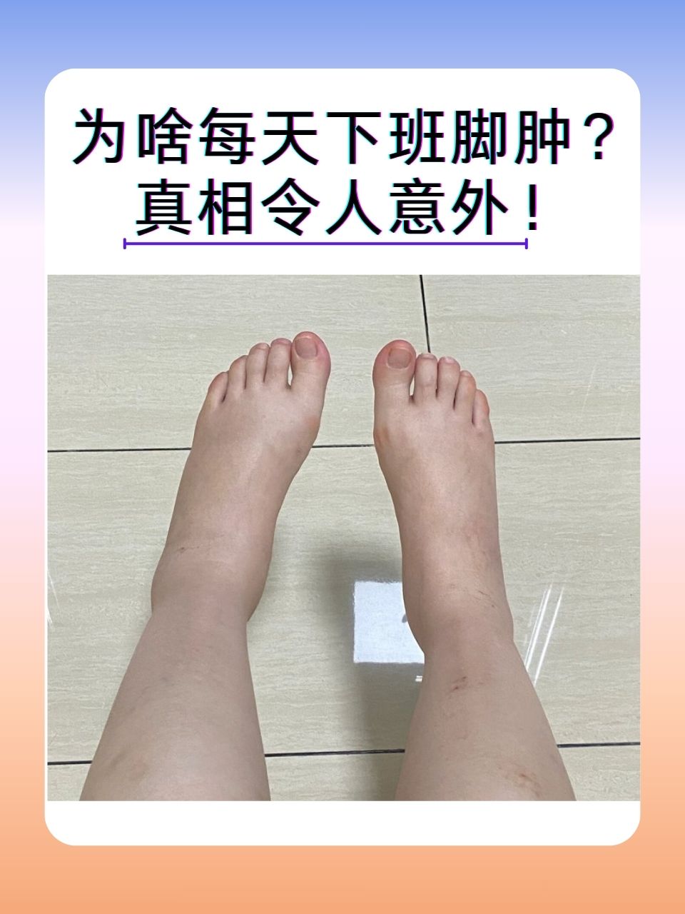 怀孕脚肿是什么原因?