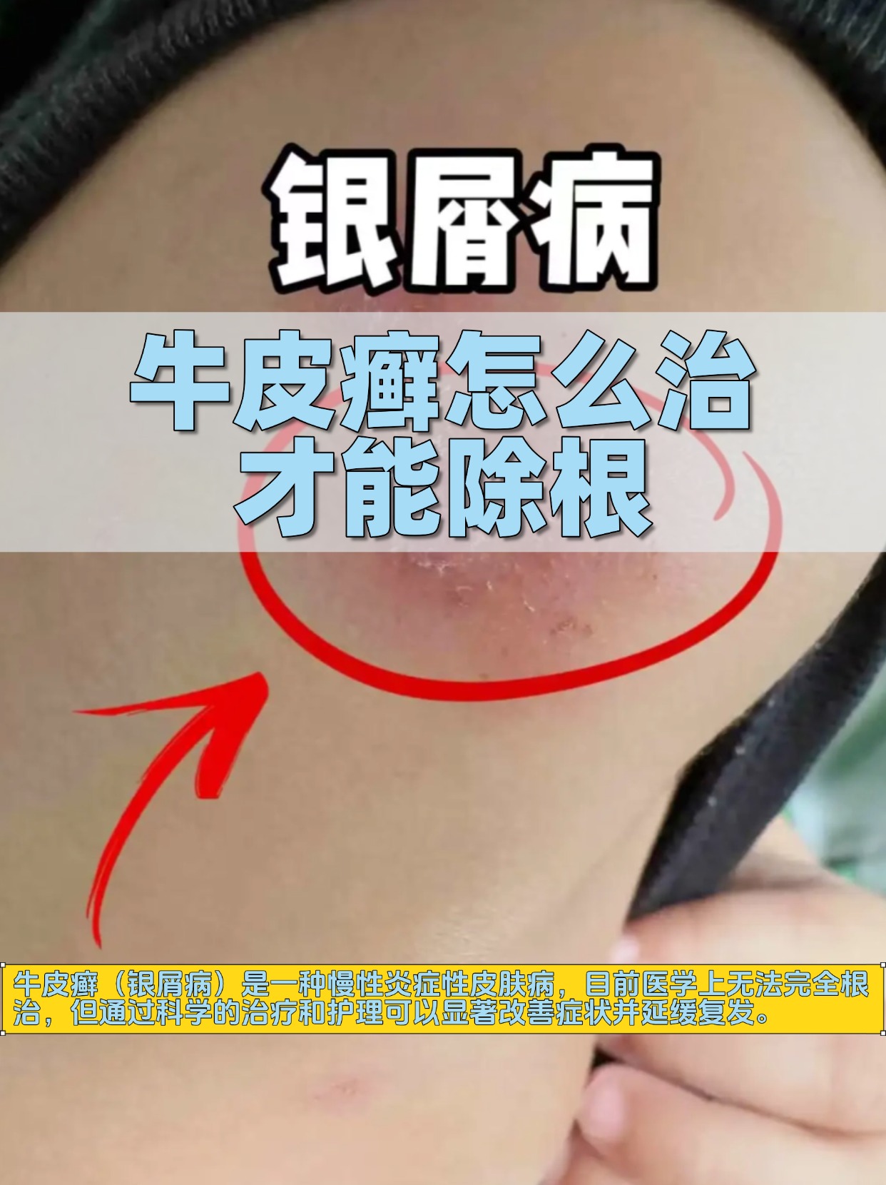 银屑病治疗效果好的方法