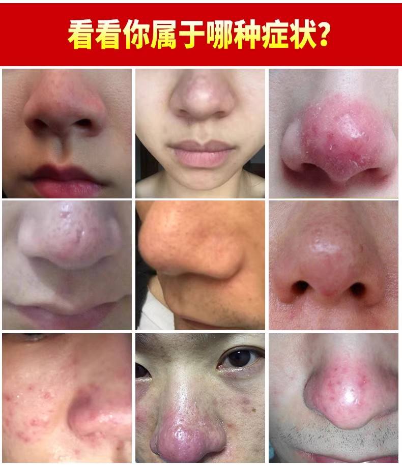 鼻子长痘怎么办