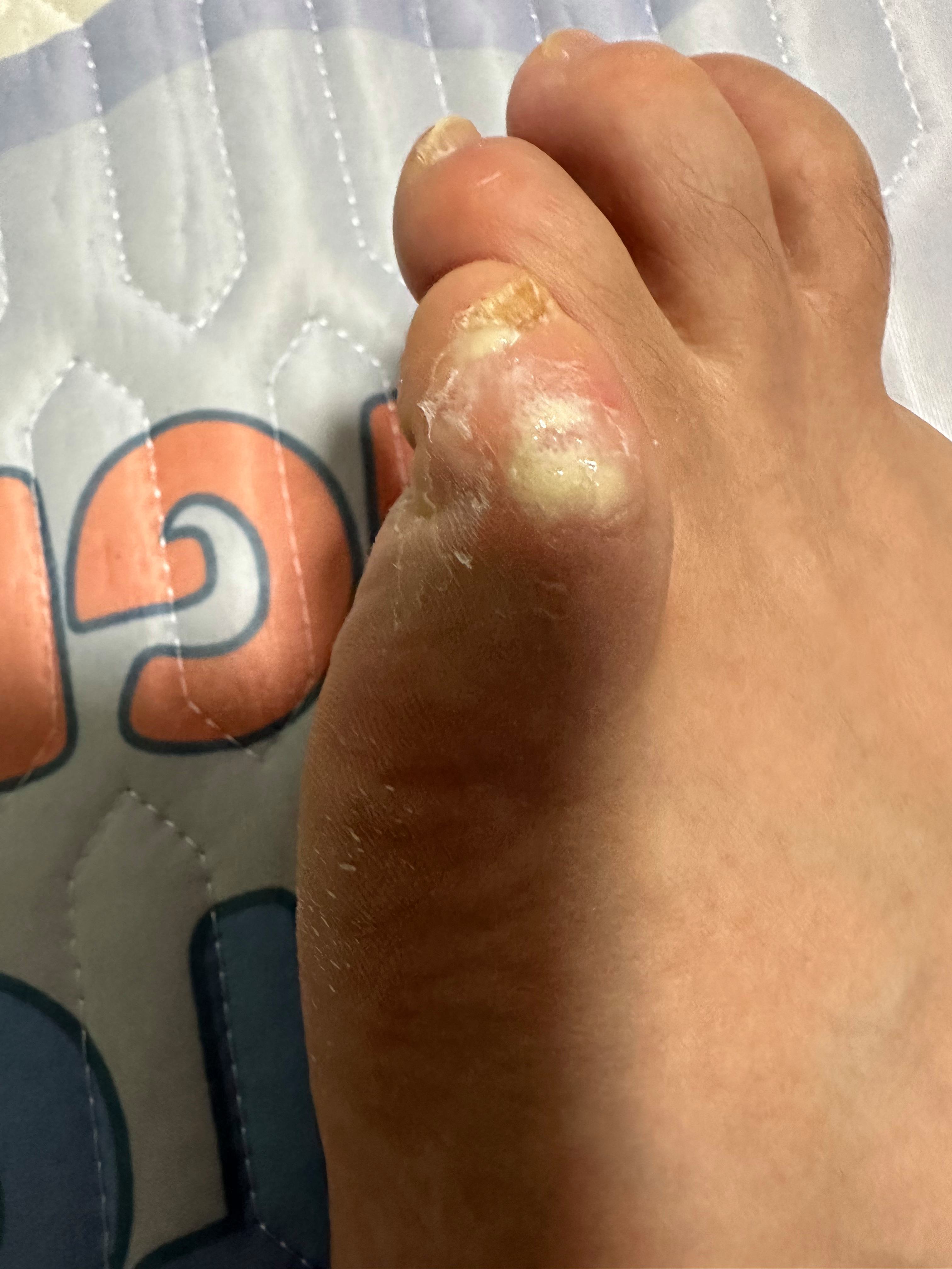 脚底长了鸡眼怎么办