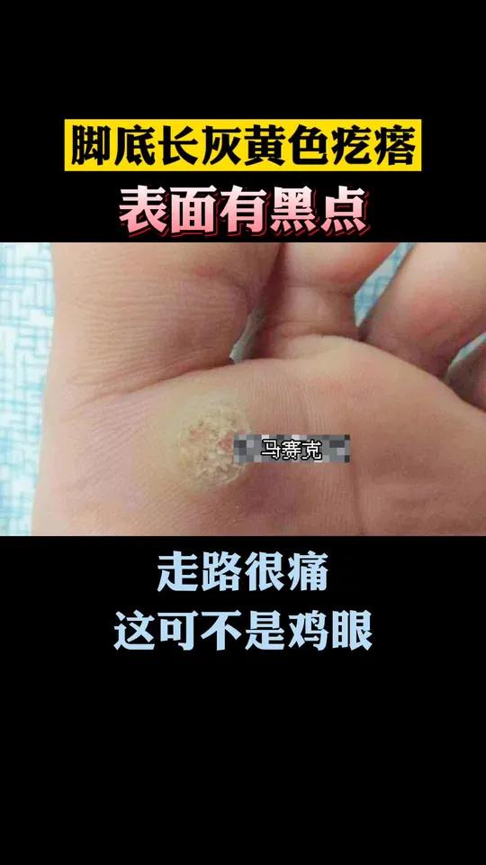 脚底长了鸡眼怎么办