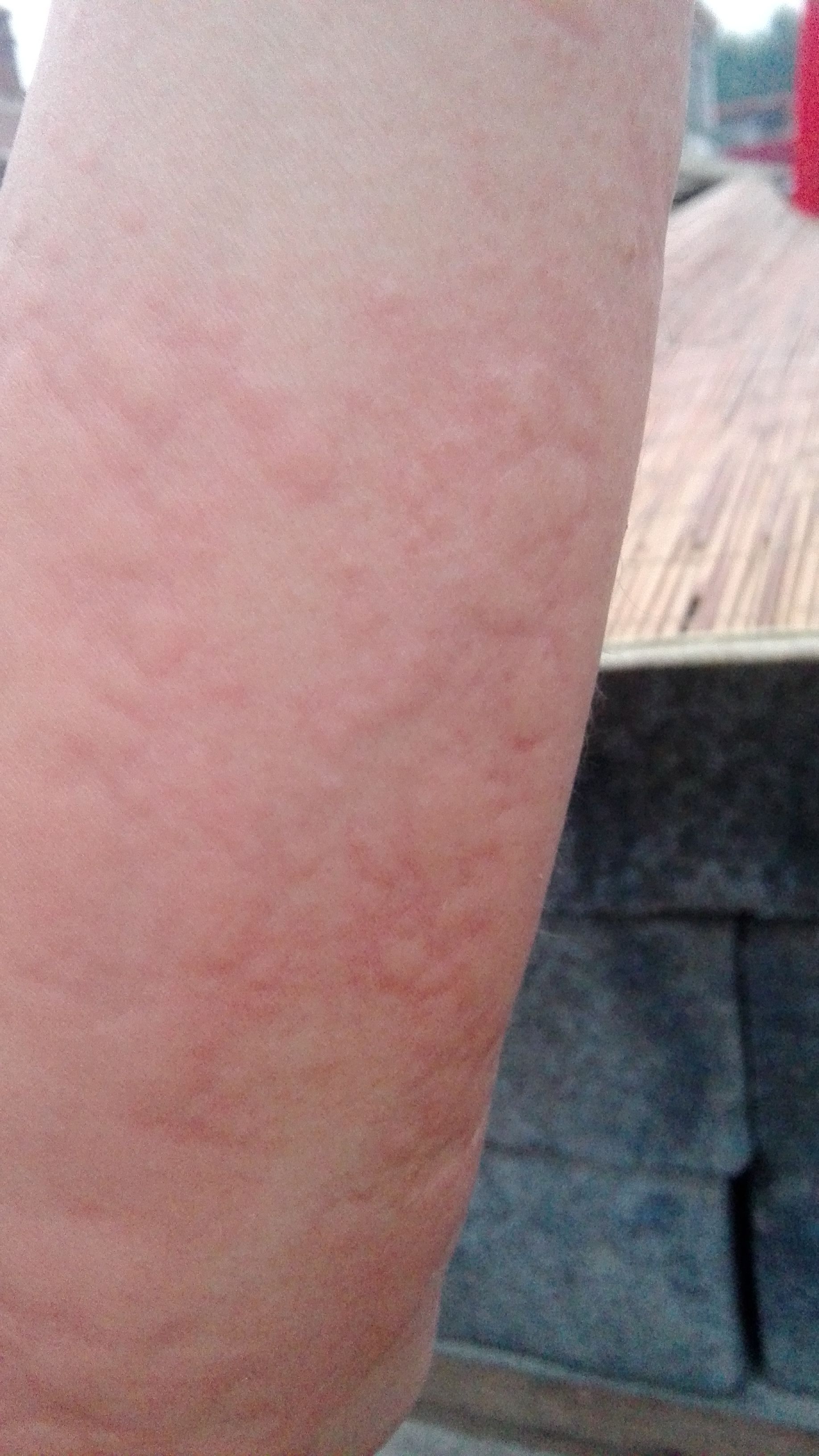 身上长红疙瘩,不痛不痒是什么?