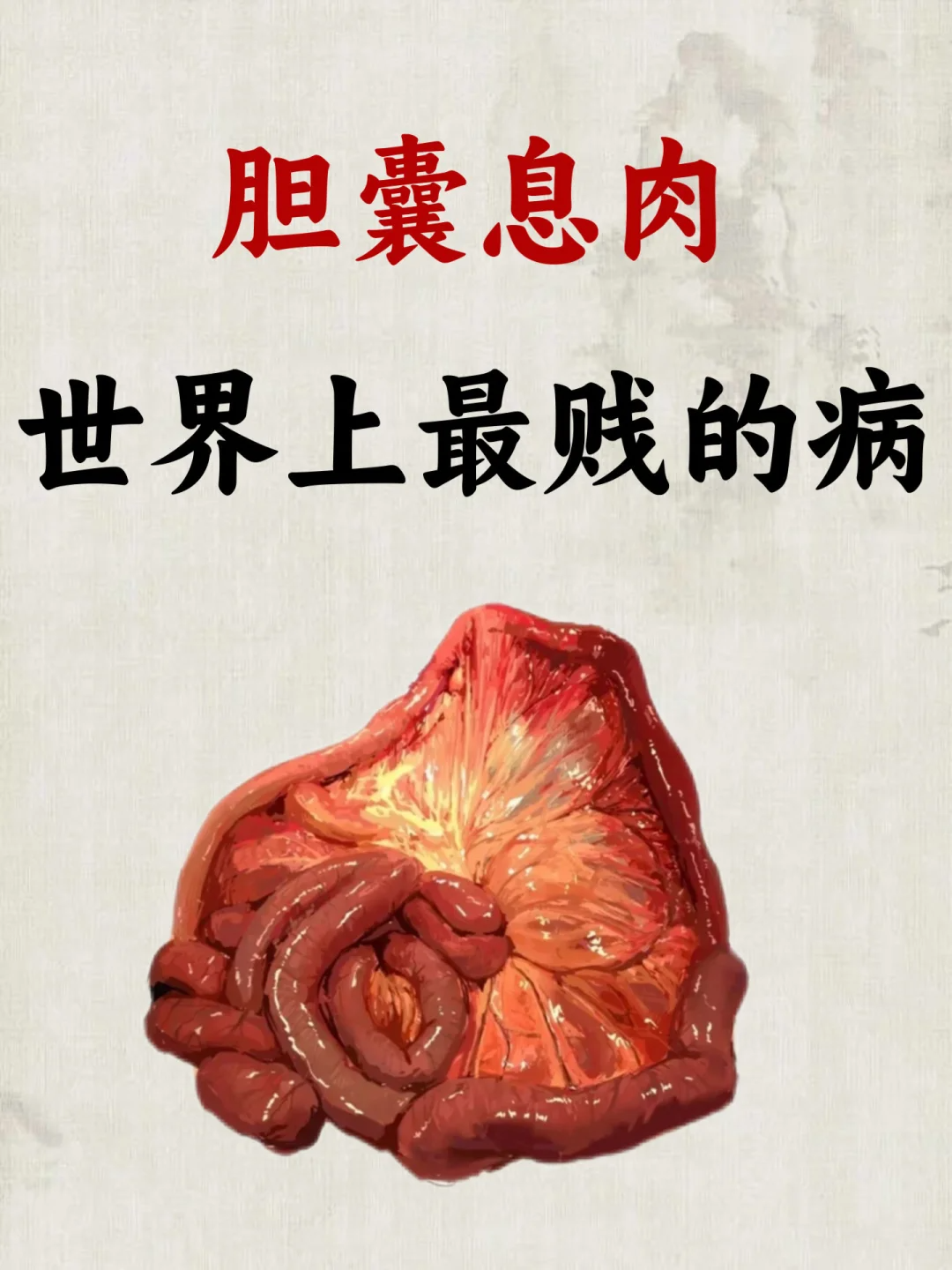 胆息肉的癌变几率有多少?