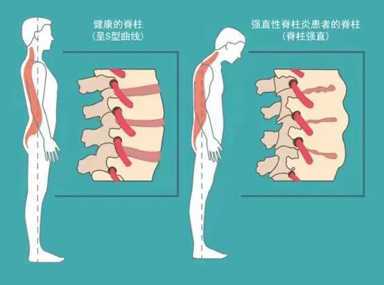 强直性脊柱炎的初期表现