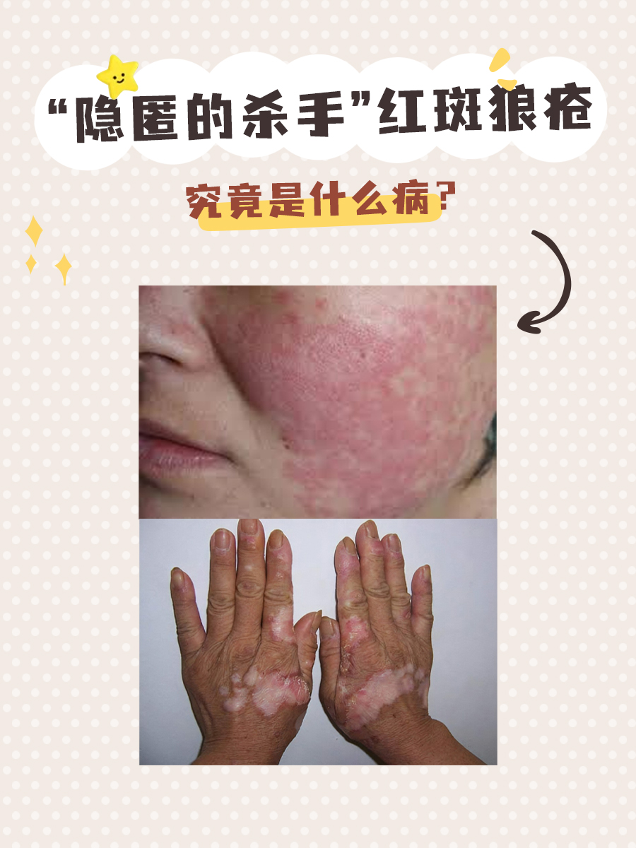 红斑狼疮有遗传吗?