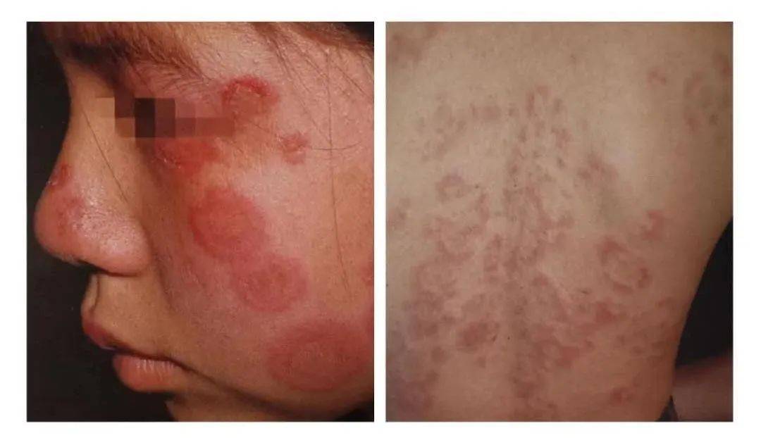 红斑狼疮有遗传吗?