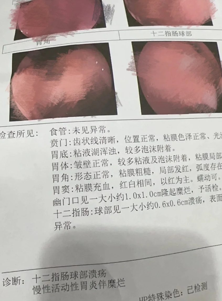 十二指肠出血什么原因