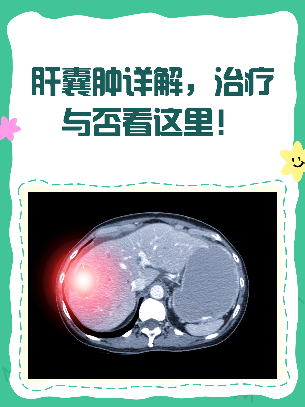 肝上长囊肿应该要注意点什么