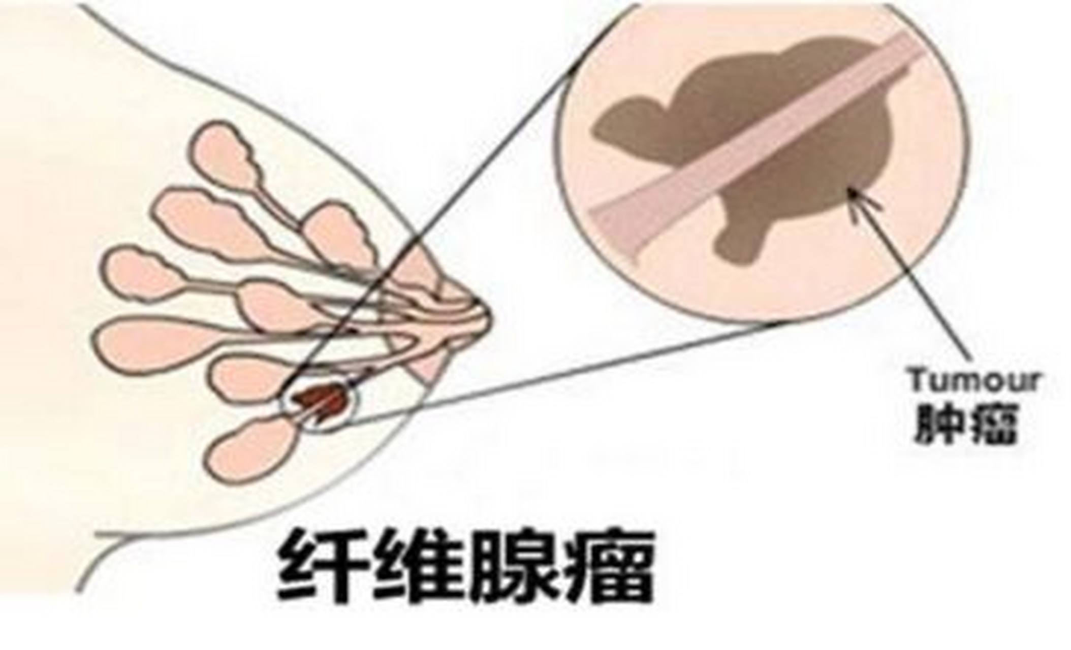 乳腺纤维瘤不切会怎样?