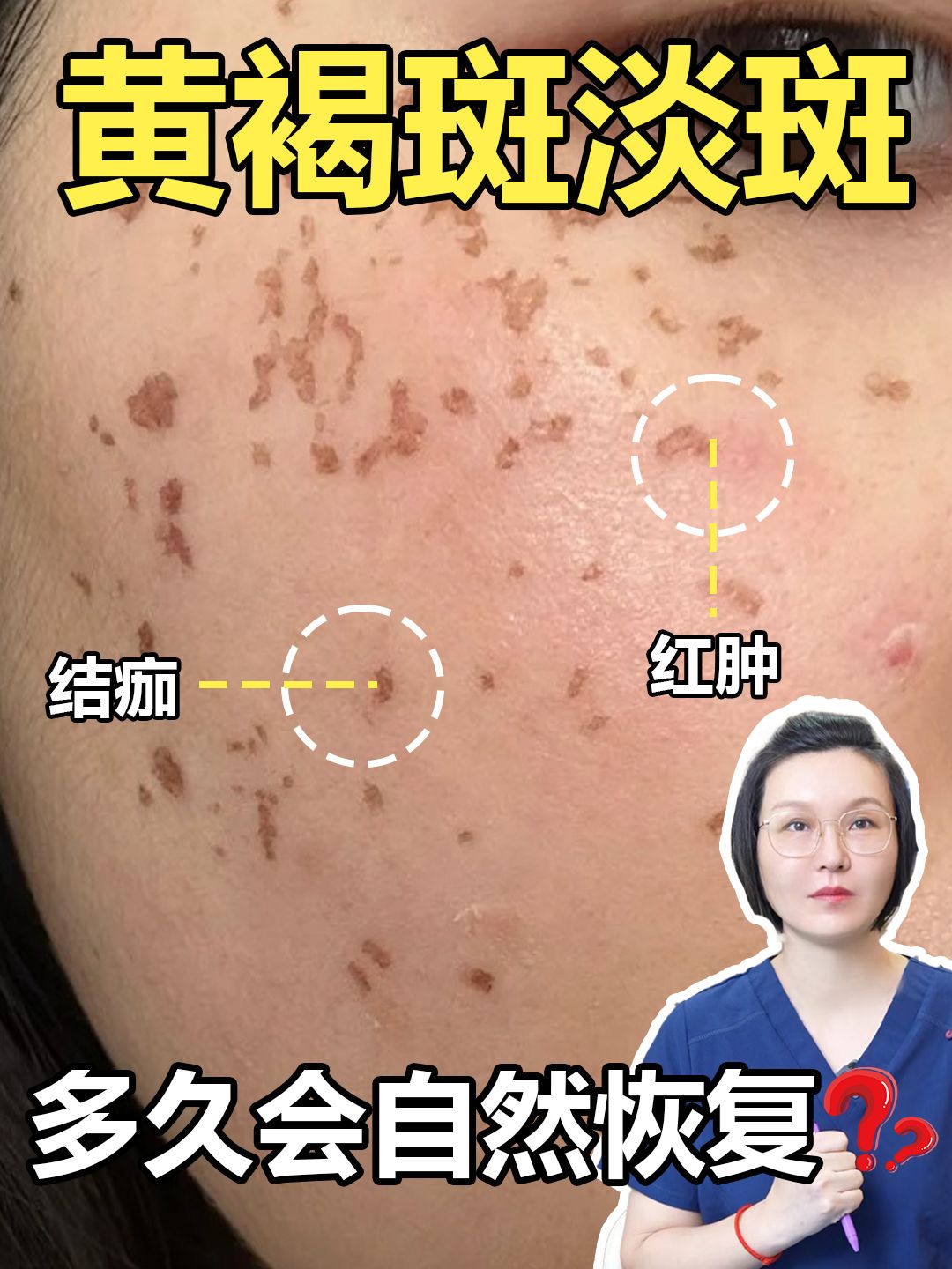 激光祛斑后多久可以化妆?