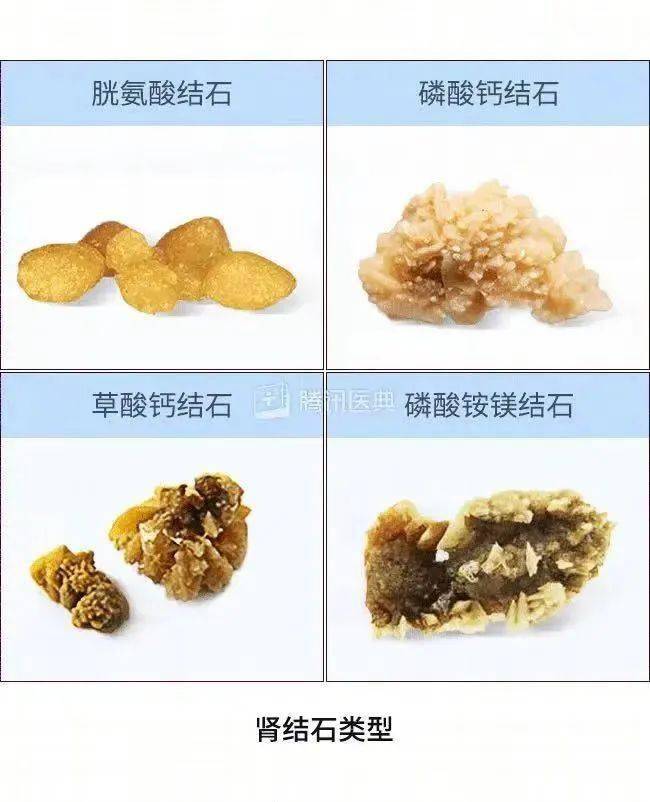 结石有几种
