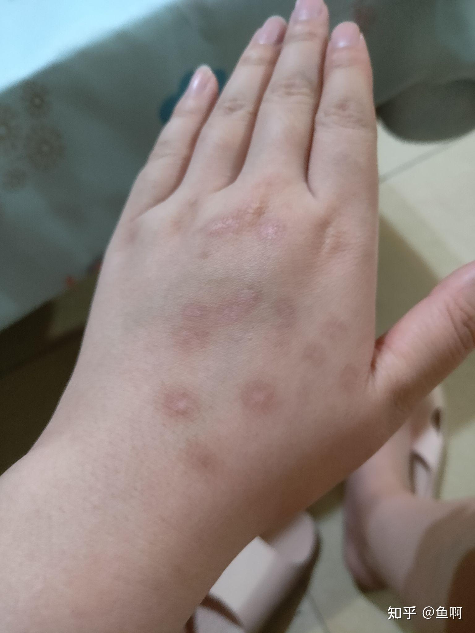 寻常疣冷冻后变黑