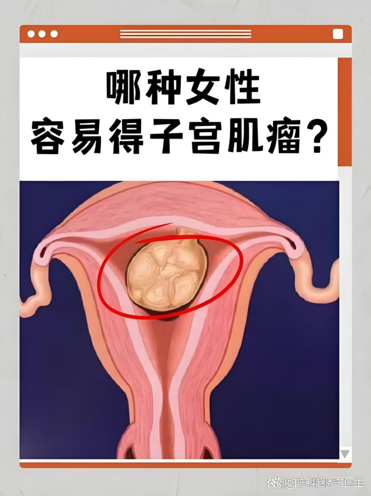 子宫肌瘤与子宫腺肌瘤的区别
