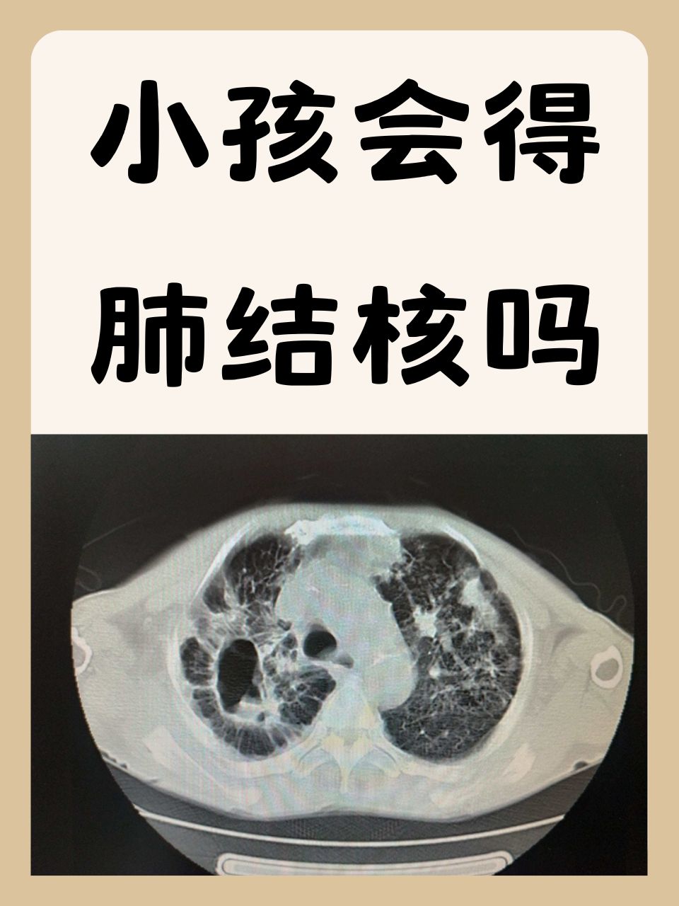 拍胸片能确诊肺结核吗