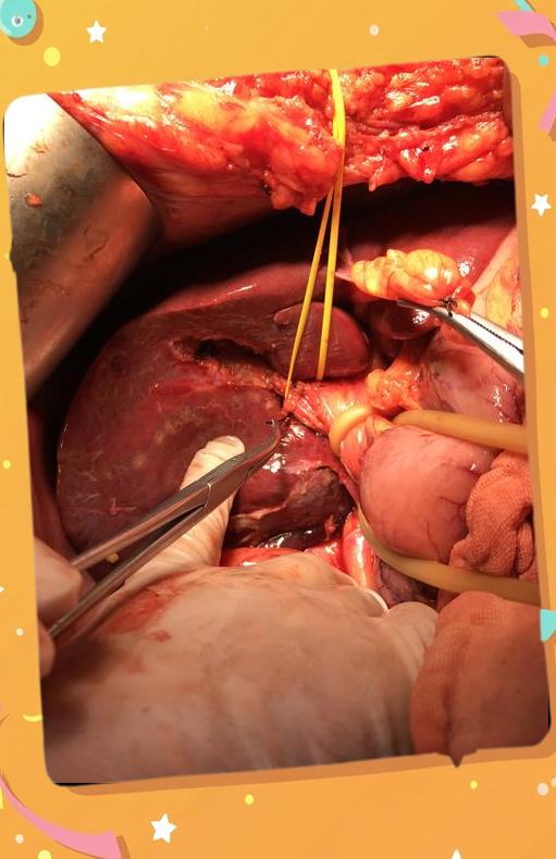 肝上长了血管瘤严重吗?