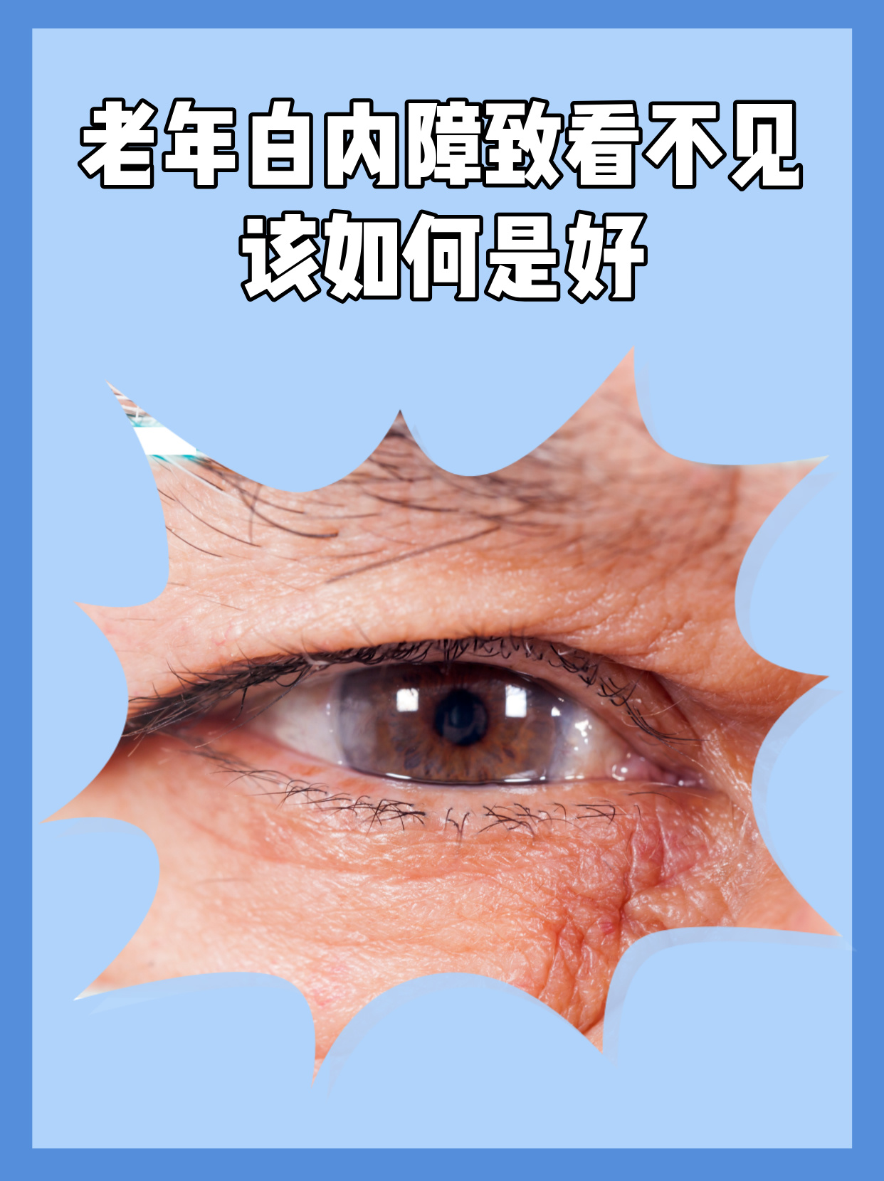 白内障早期怎么办