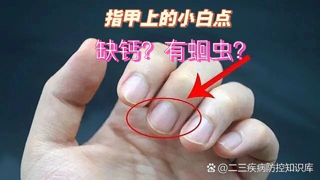 指甲上有白点怎么回事