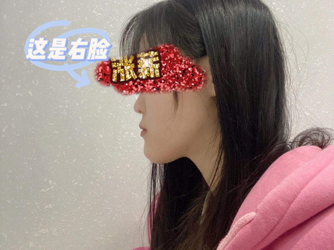 侧脸看嘴巴有点前突,正面看的话没有那么明显