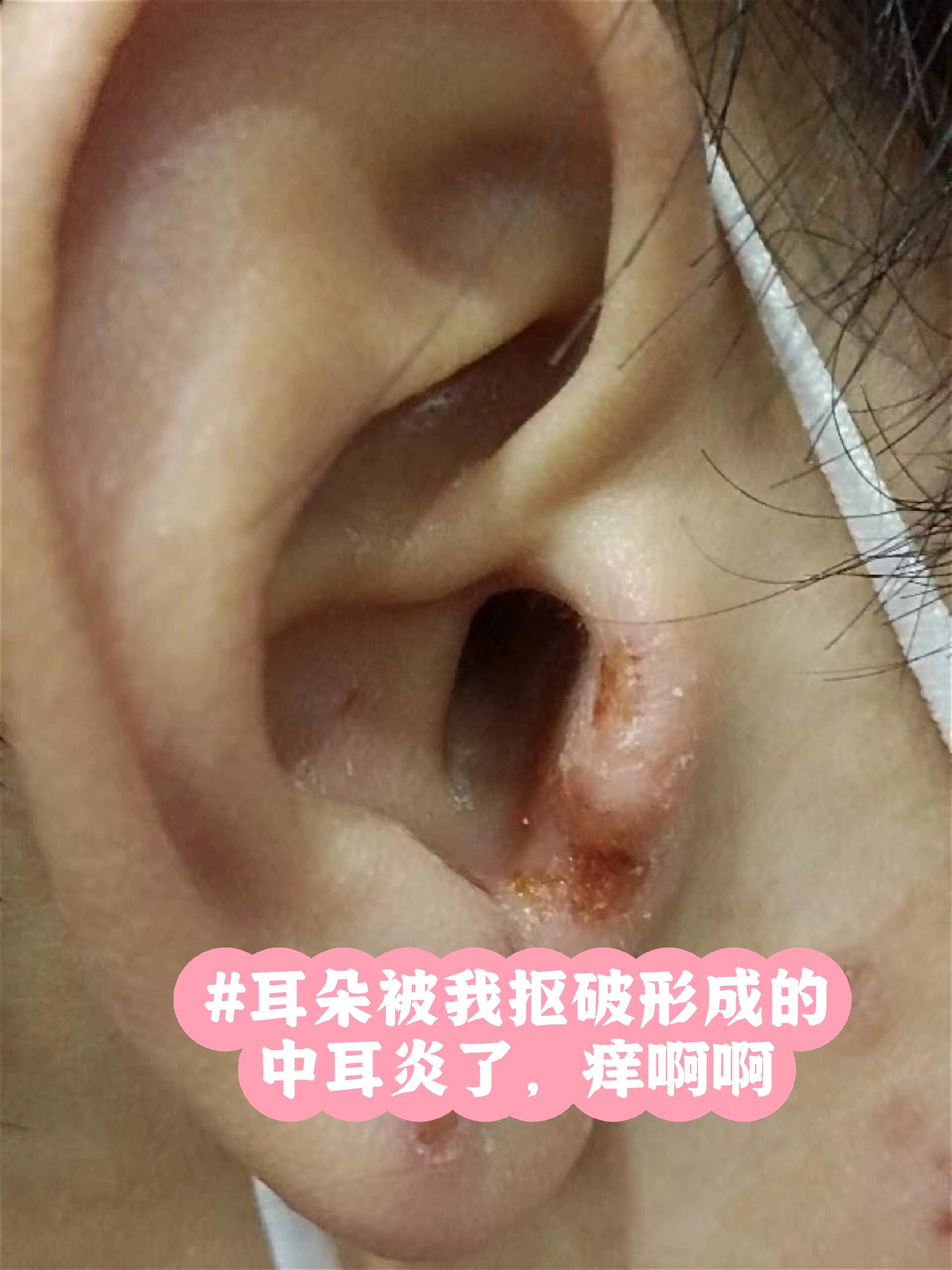 儿童中耳炎的症状