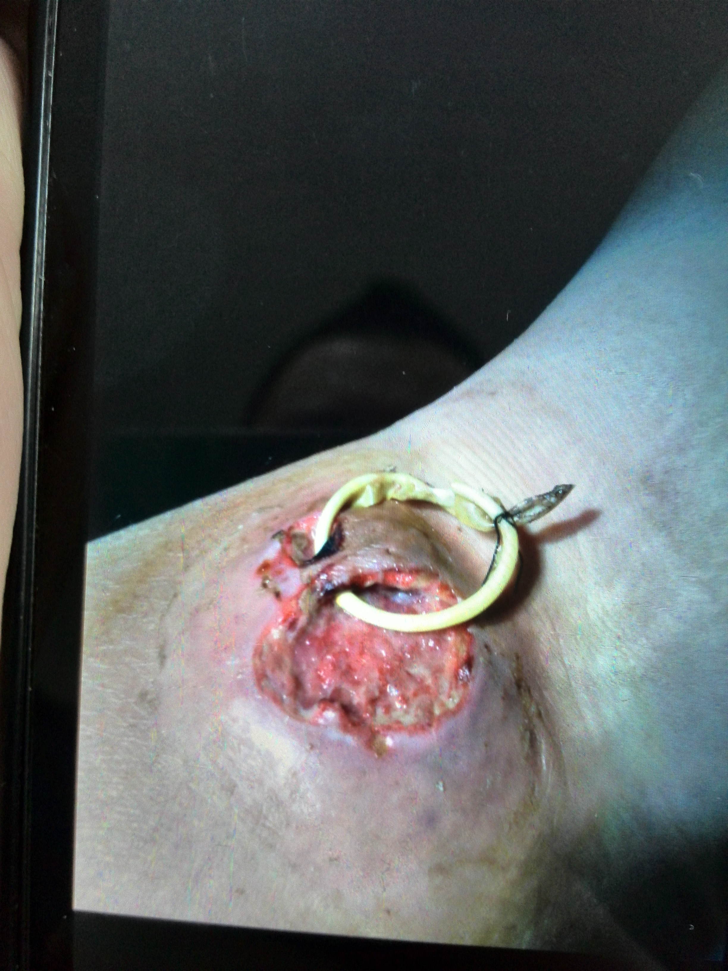 蜂窝织炎是什么