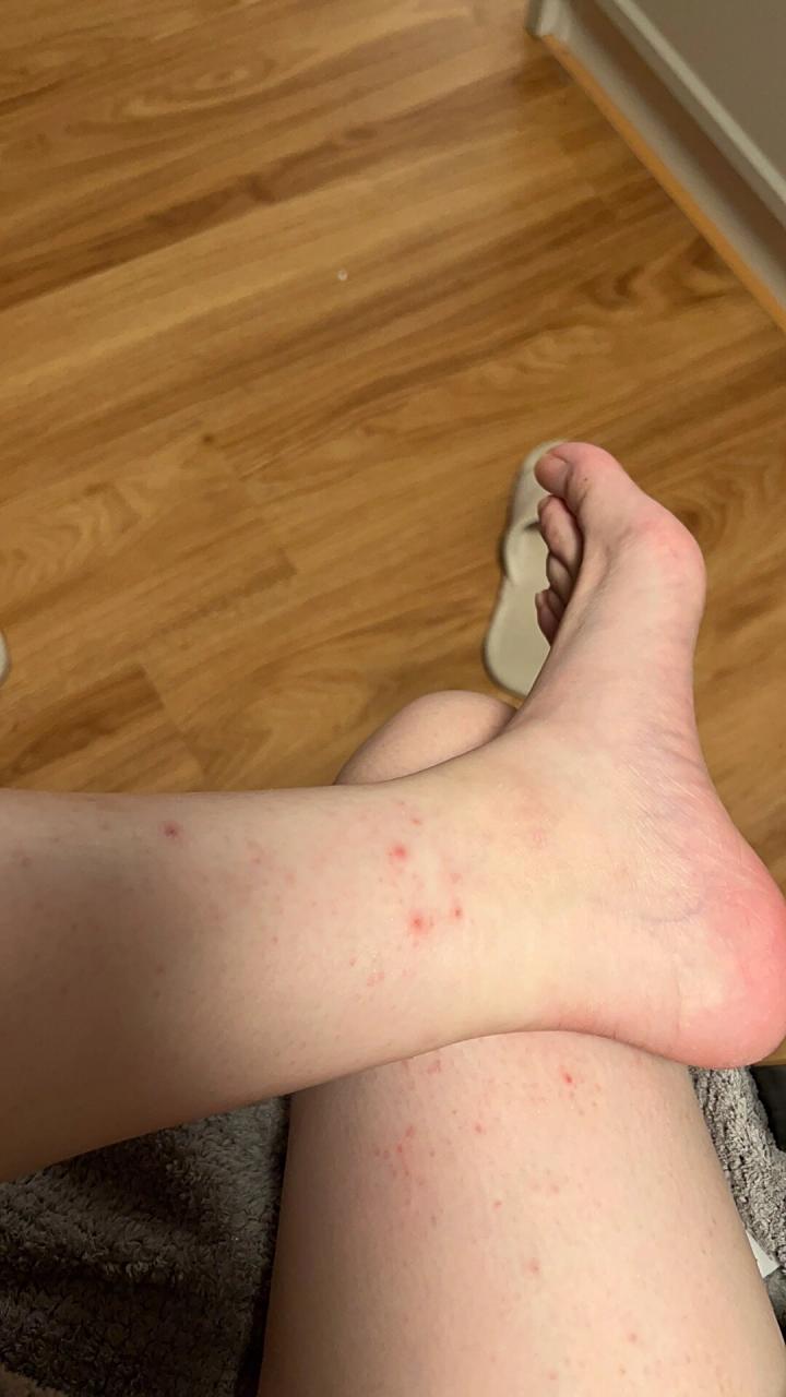 一到晚上睡觉身上就痒