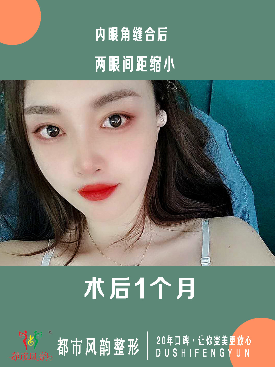 眼角开大怎么修复