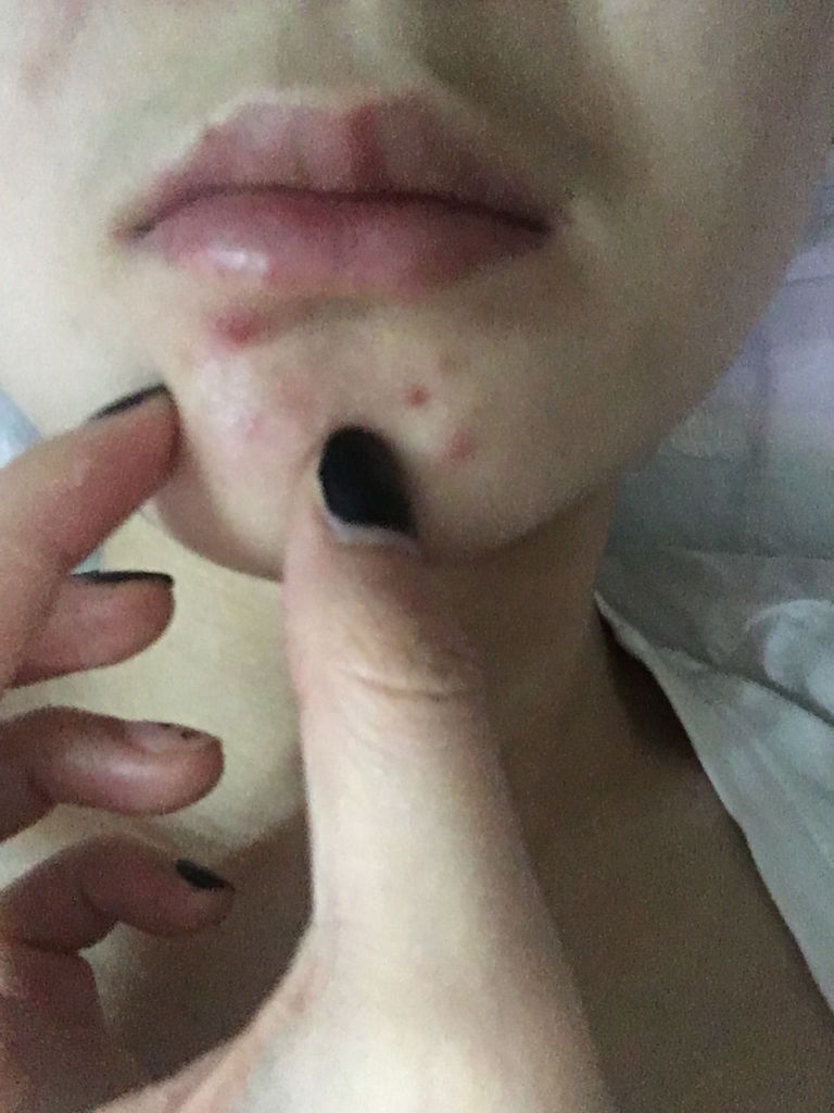 下巴下面有一个硬疙瘩