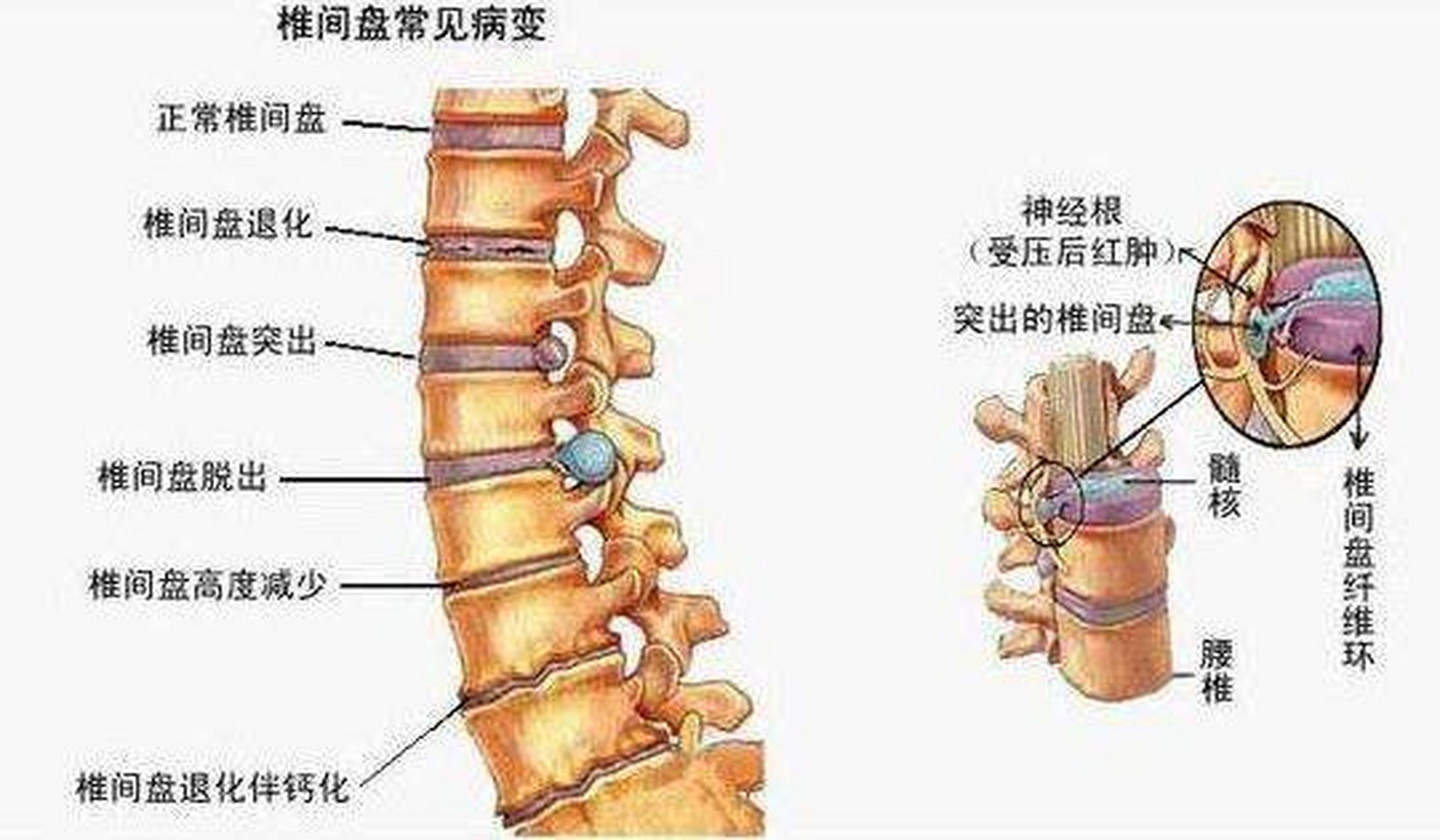 什么是腰椎管狭窄