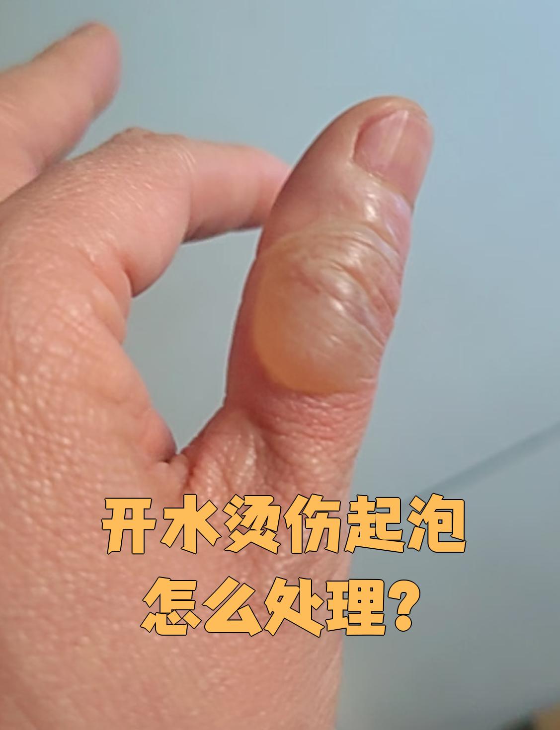 开水烫伤起泡怎么办?
