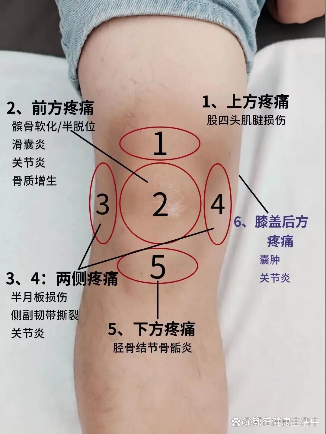 膝盖积水怎么治疗