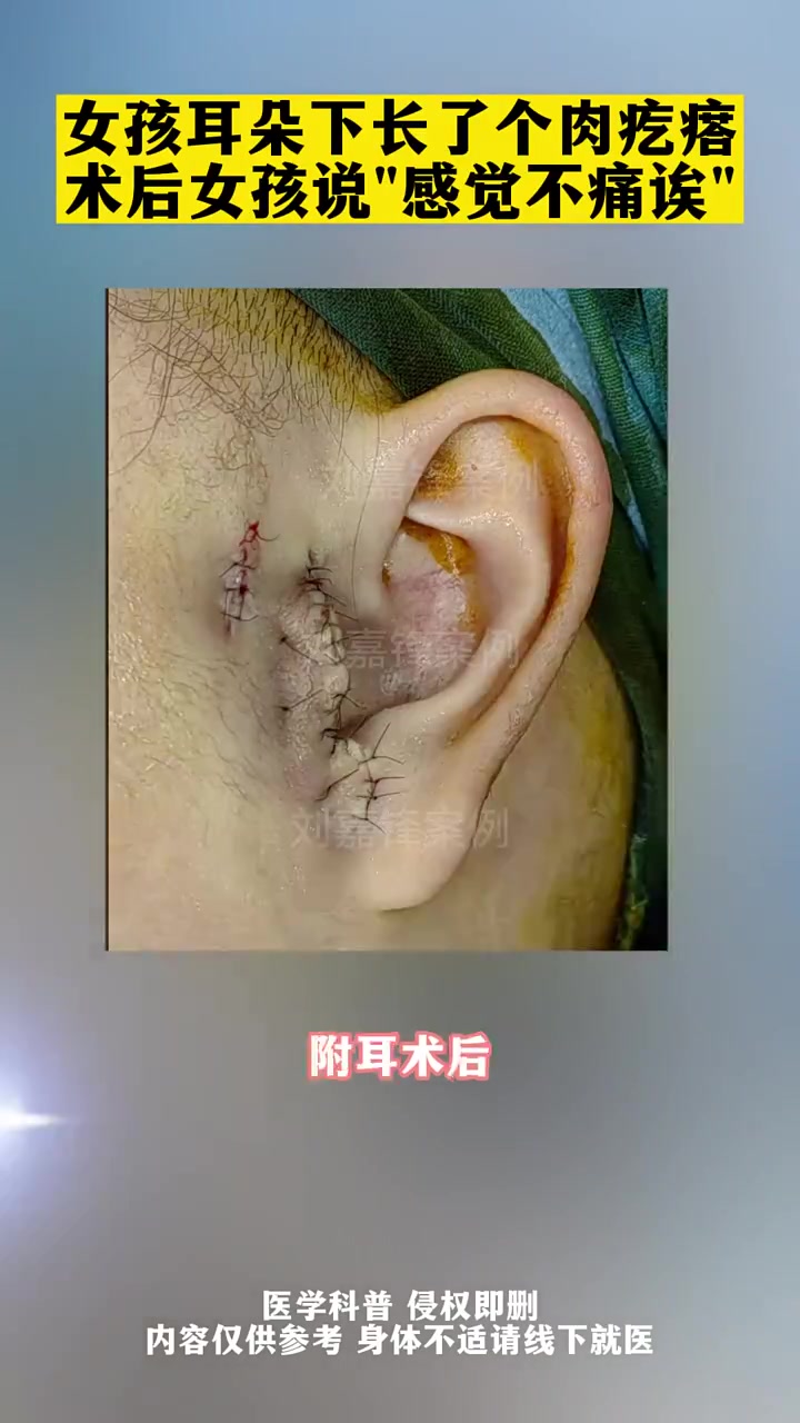 耳垂下面长了个硬疙瘩