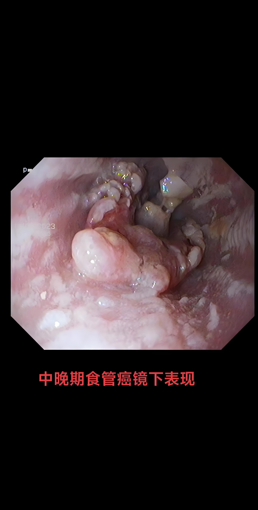 感觉食道里有东西堵着