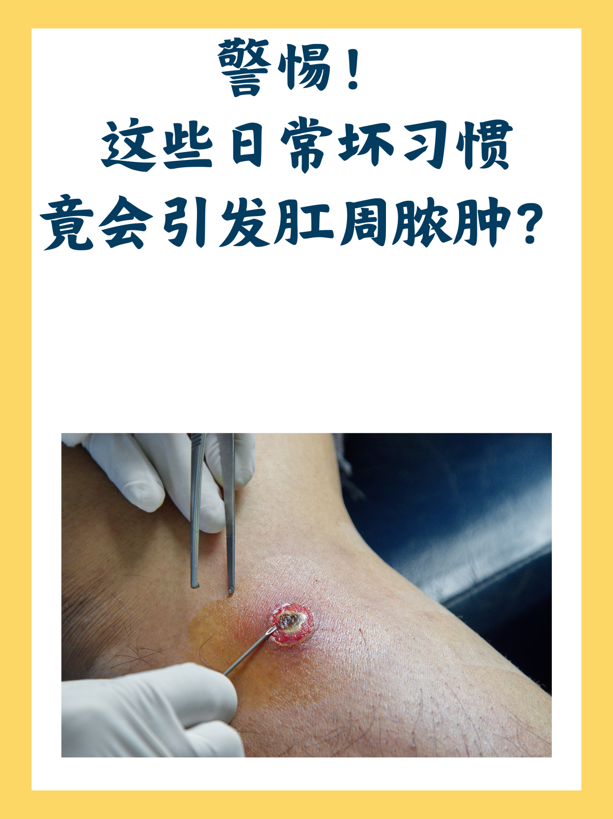 肛周脓肿会自愈吗?
