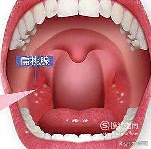 扁桃腺发炎症状