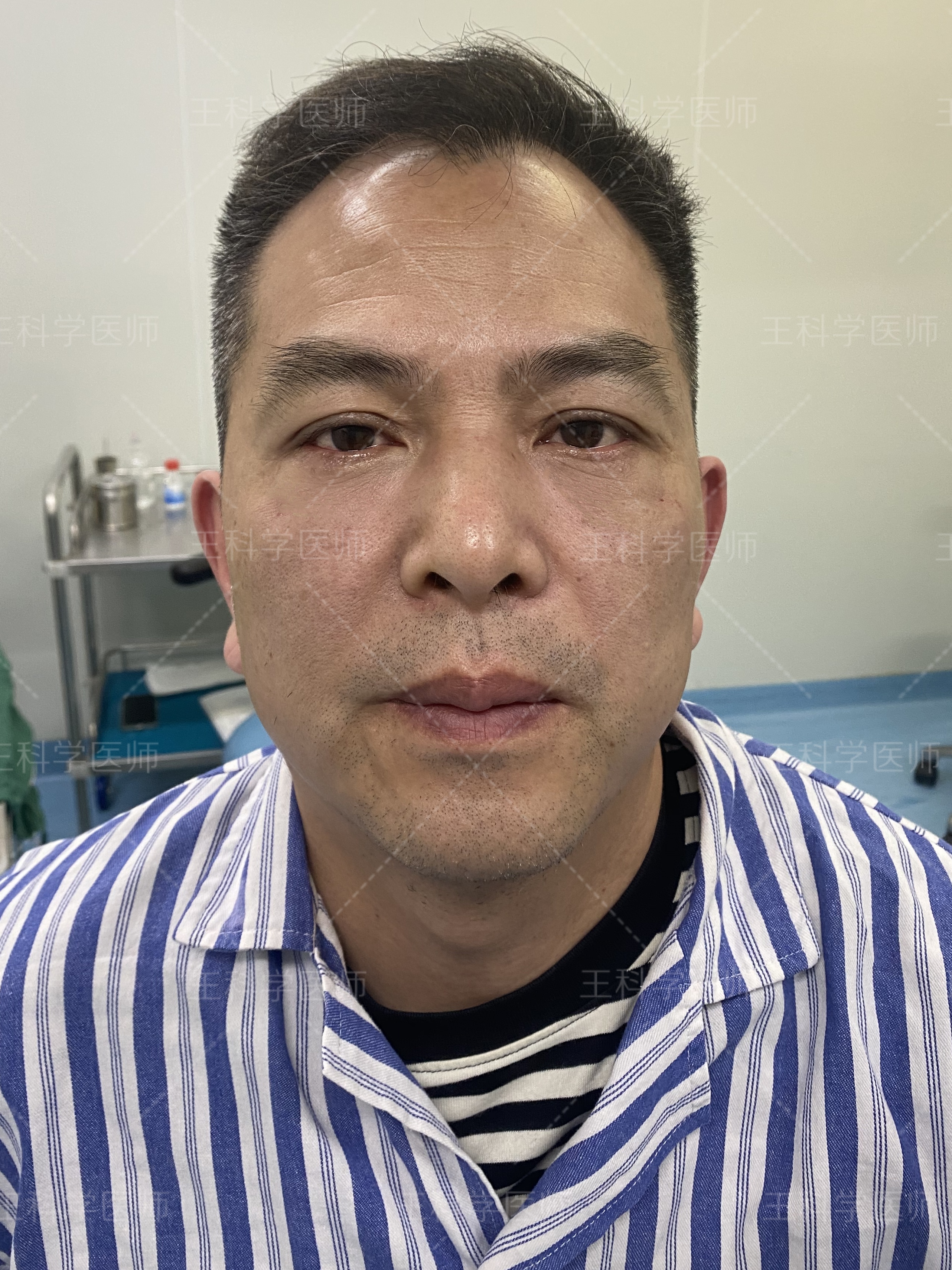 去除眼袋手术