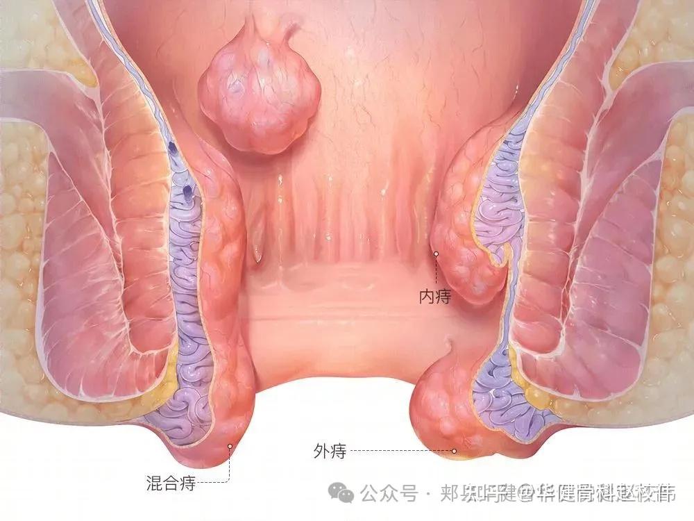 什么是肛乳头瘤?