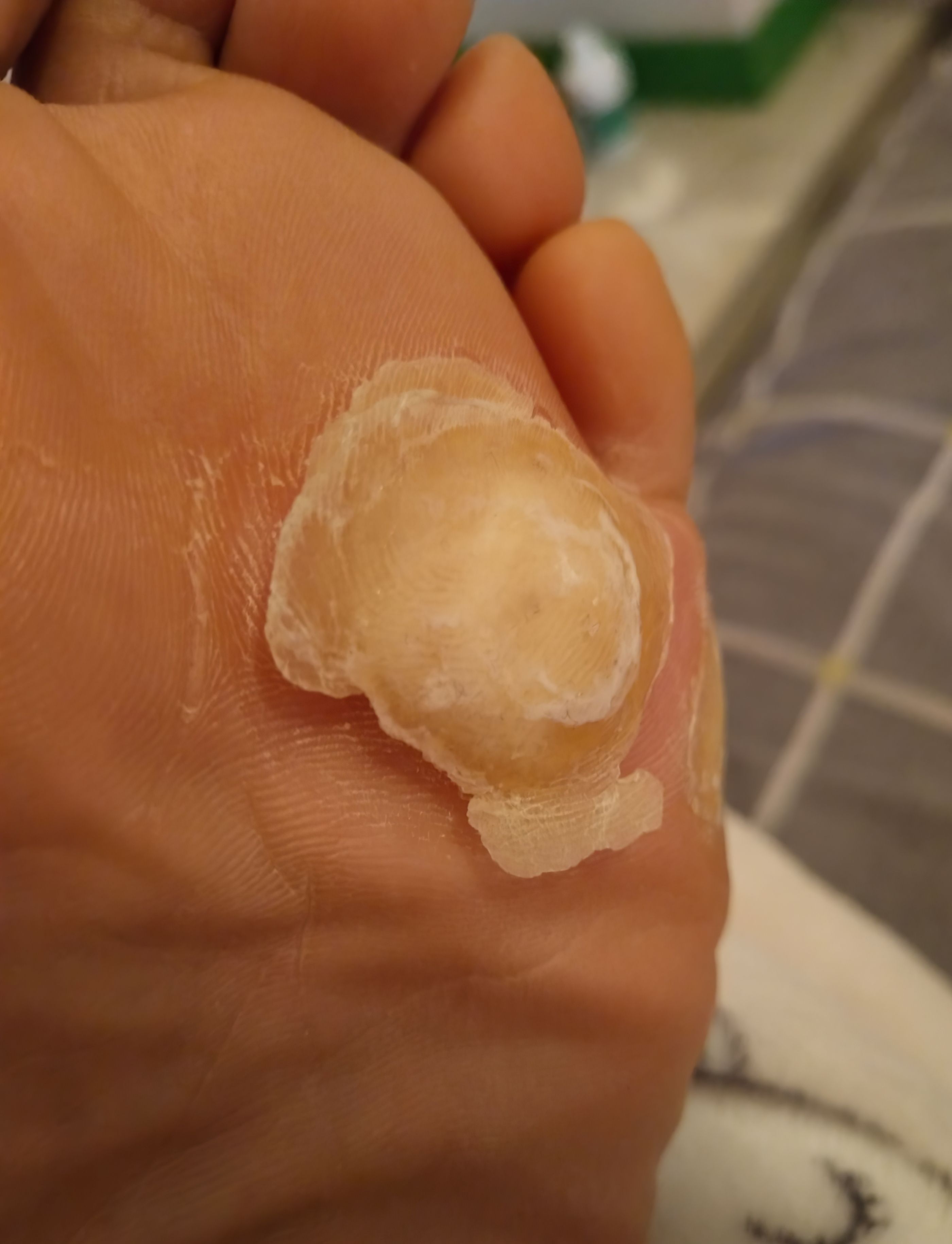 脚上长鸡眼是什么原因