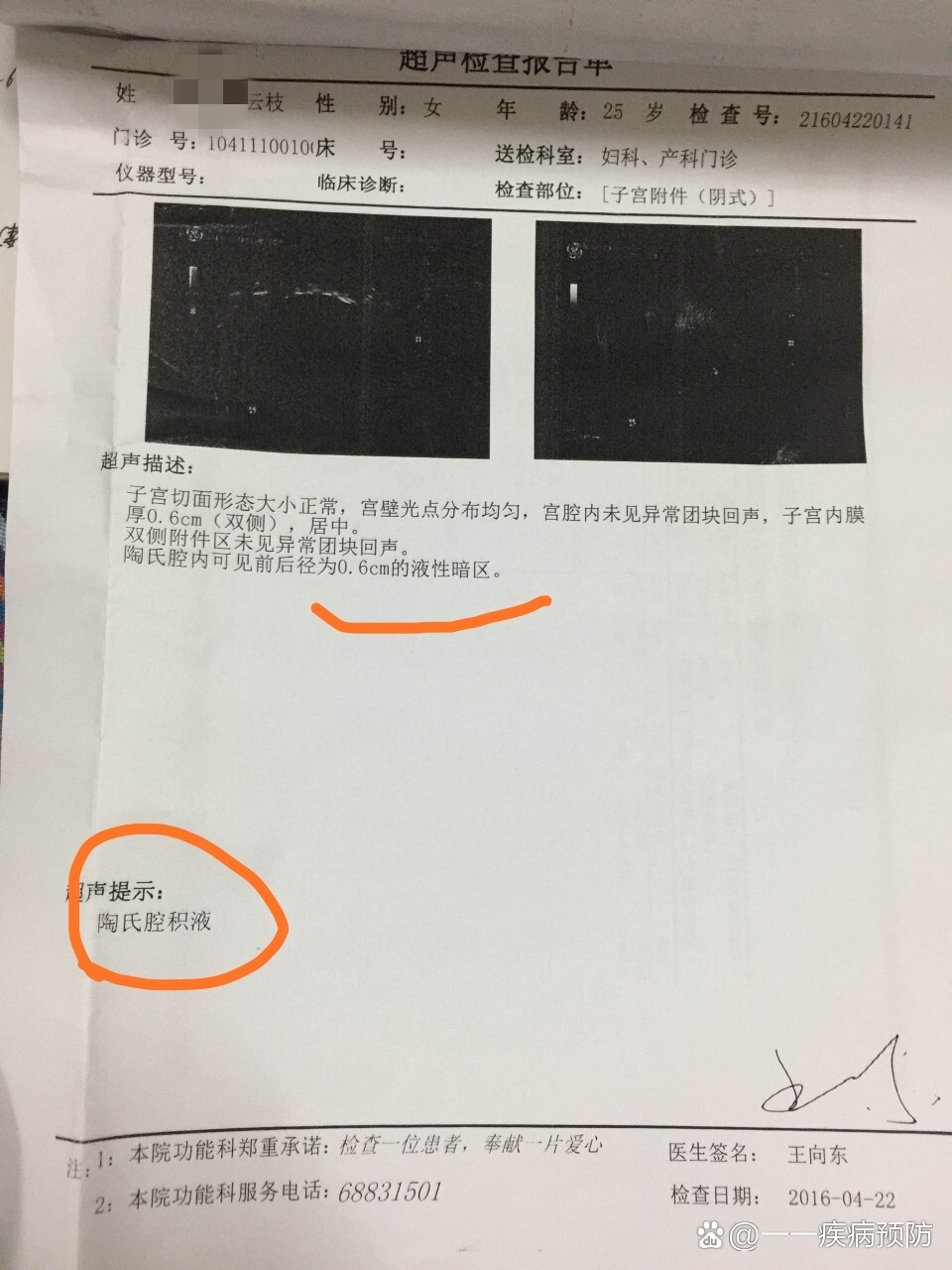 陶氏腔积液是怎么回事