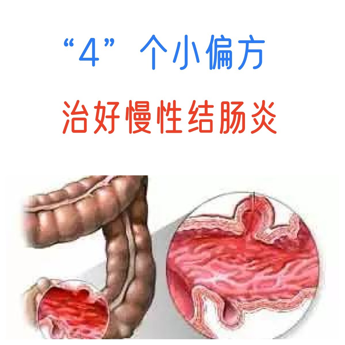 结肠炎怎么治?