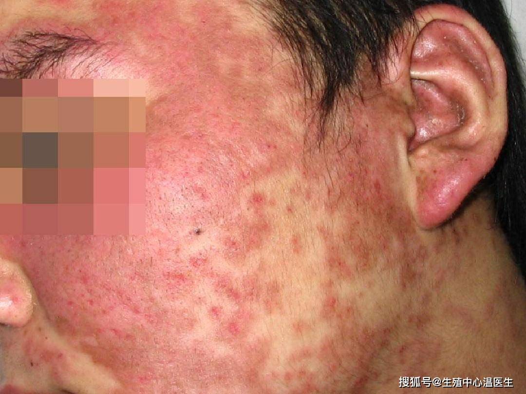 女性红斑狼疮患者能活多久?