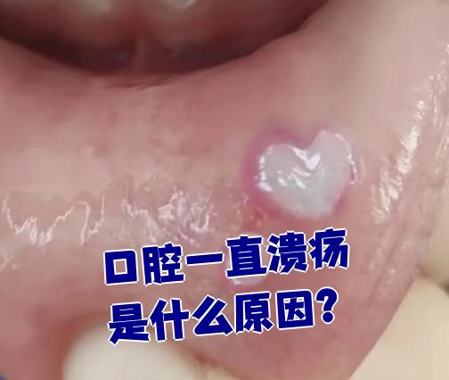 口腔厌氧菌感染的症状有哪些