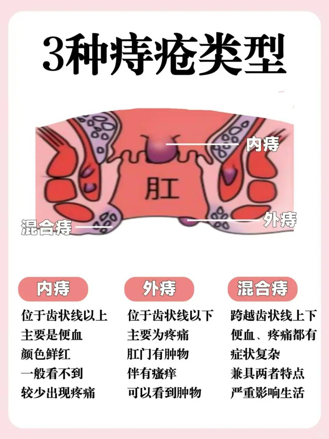 得痔疮的症状有哪些