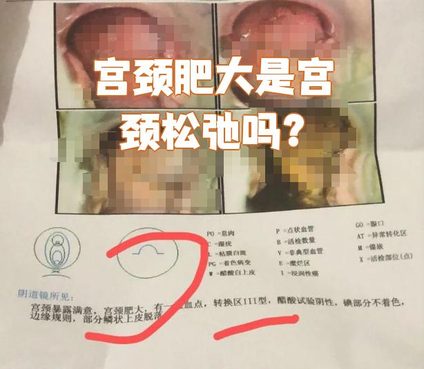 宫颈口肥大是怎么回事