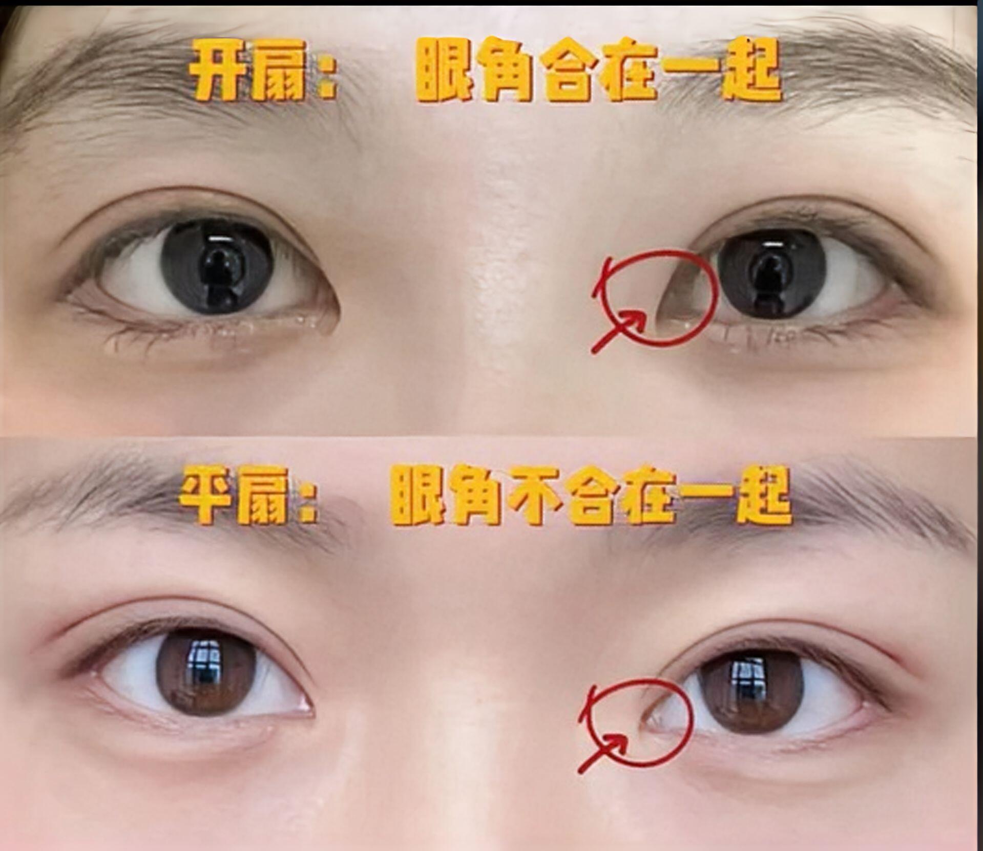 怎么割双眼皮?