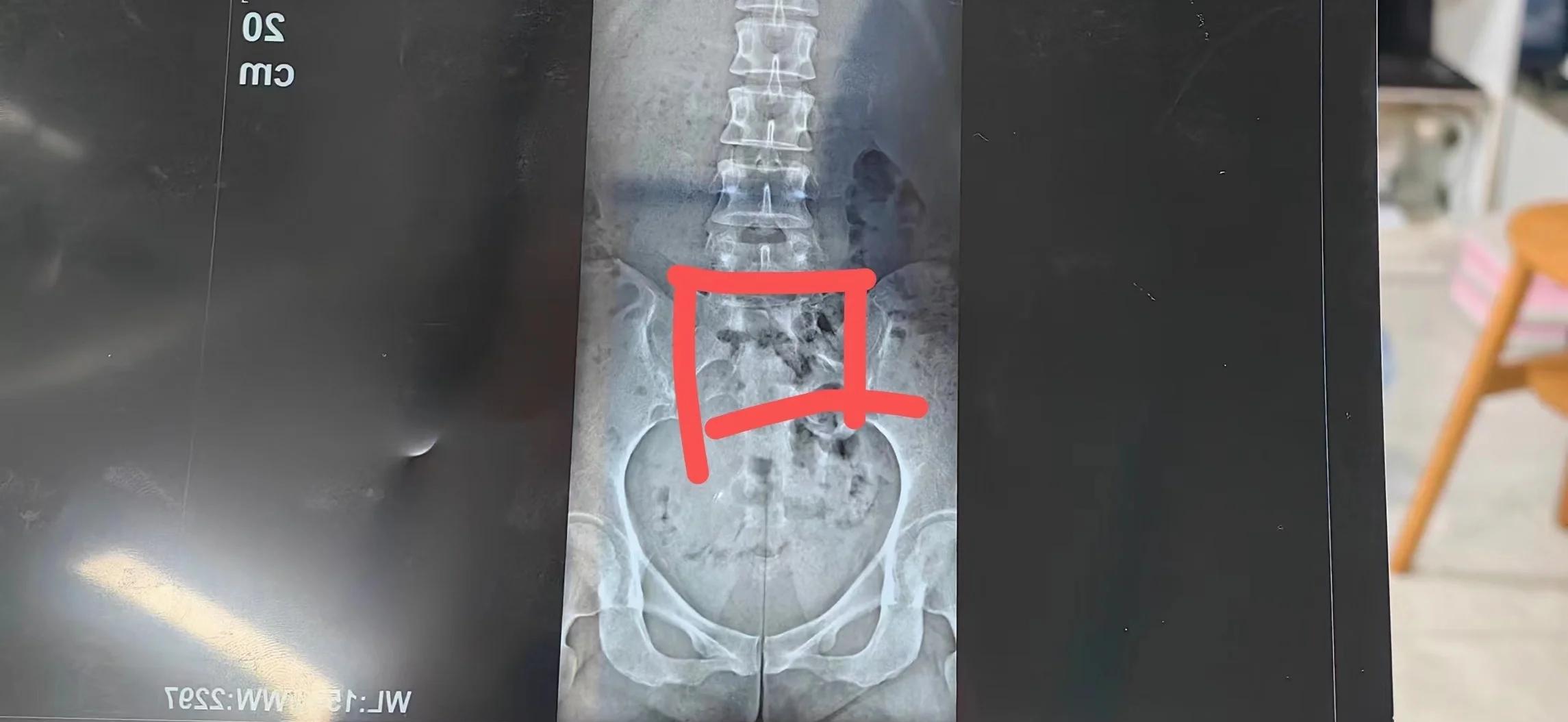 骶骨骨折老是感觉腿发软