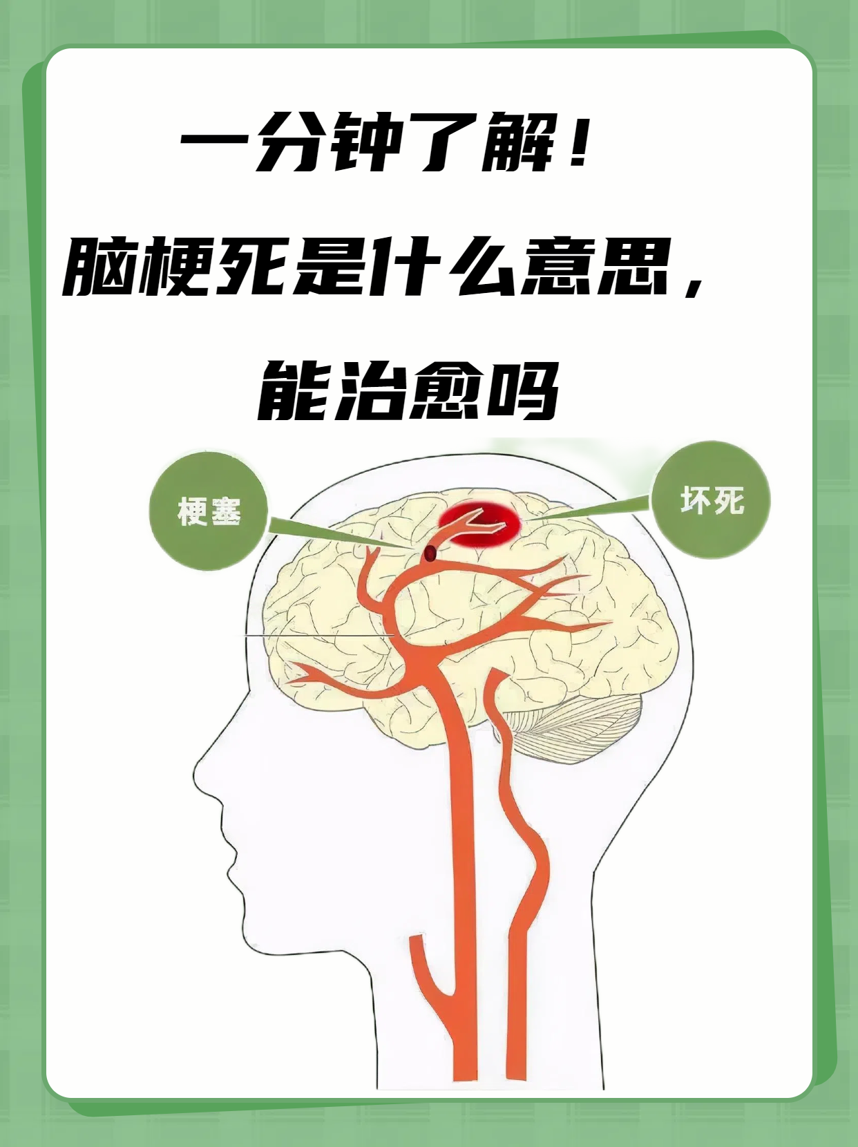 脑梗的前兆